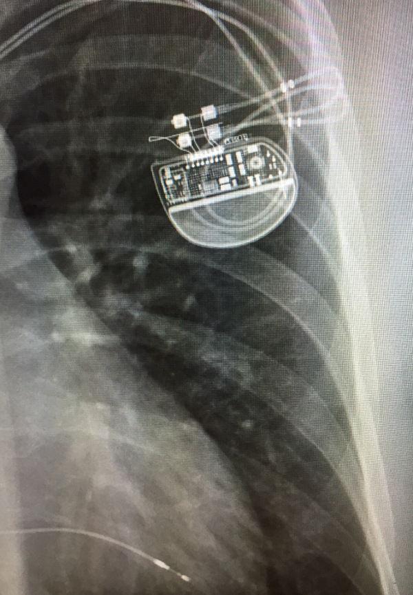 Herzschrittmacher X-Ray